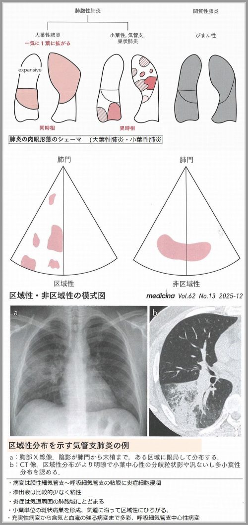 肺炎・区域・治療期間