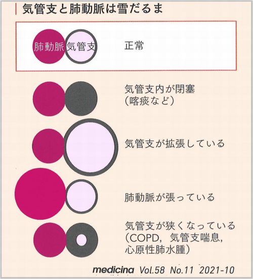 気管支の評価(肺動脈との関係)