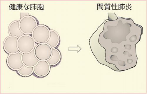 間質性肺炎のイメージ