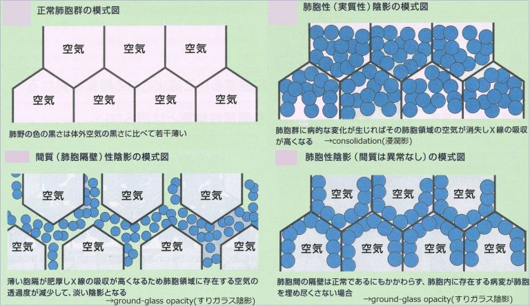 肺の構造(気管から肺胞まで)|胸部写真の読み方|太田東こども&おとな診療所|こどもとおとなの病気について、気軽に相談できる診療所です。