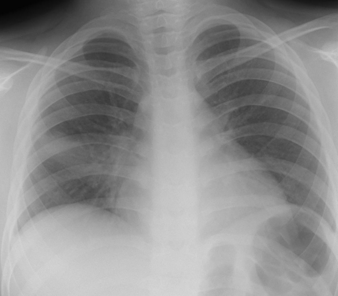 肺の構造 気管から肺胞まで 胸部写真の読み方 太田東こども おとな診療所 こどもとおとなの病気について 気軽に相談できる診療所です